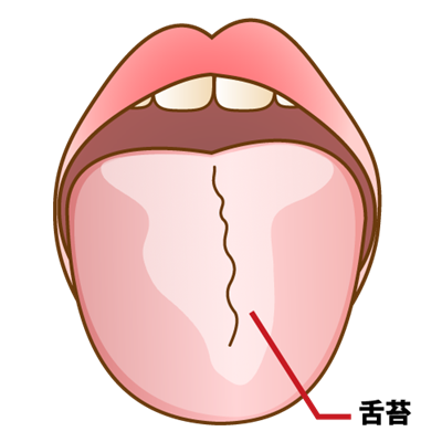 舌の汚れ「舌苔」除去で新たなコロナ対策